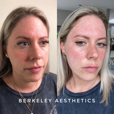 CLAIRE Treatment before and after superficial chemical peel